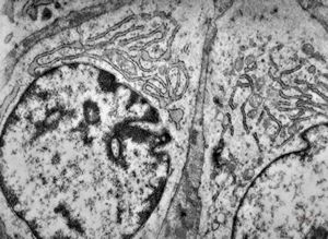 M,1y. | neuroblastoma - submandibular region M,1y. | neuroblastoma - submandibular region